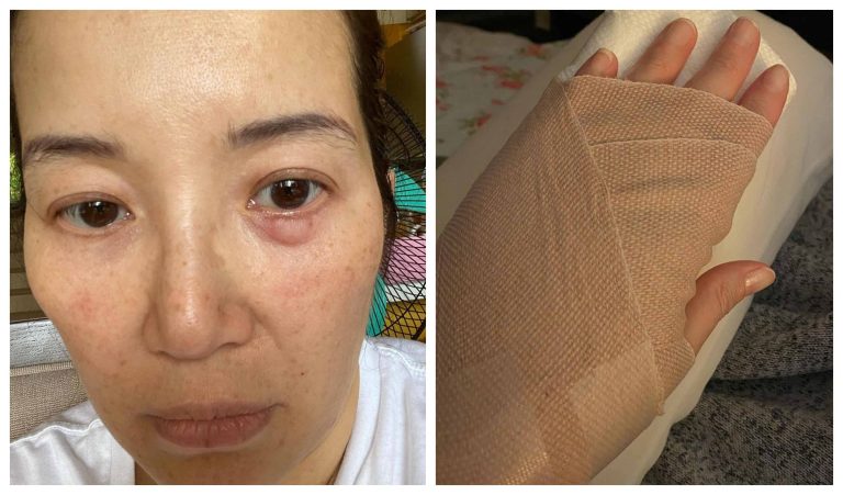 Kris Aquino issues warning after ‘super bad’ allergic reaction, hand injury