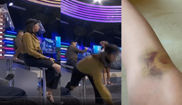 Maine Mendoza gets bruised leg after accident on set of Bawal Judgmental