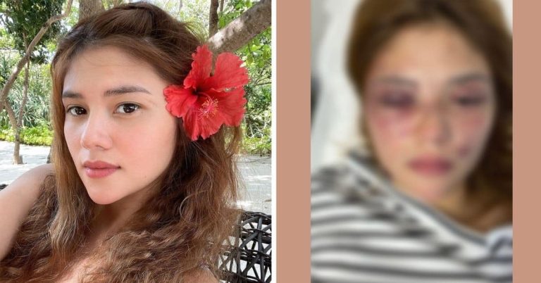 After alleged physical assault by Kit Thompson, Ana Jalandoni asks: ‘Minahal mo ba talaga?’