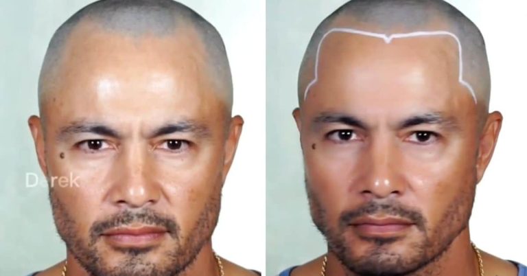 LOOK: Derek Ramsay gets ‘hyperrealistic scalp tattoo’ on hairline